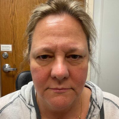 Before Endo brow lift