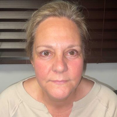 after Endo brow lift, bilateral upper eyelid ptosis repair, bilateral lower eyelid blepharoplasty with canthoplasty,CO2 laser eyes