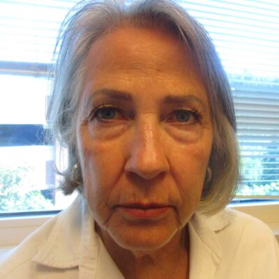 Before: Full brow lift, bilateral upper lid ptosis repair, bilateral lower lid blepharoplaty, CO2 laser resurfacing lower eyelids