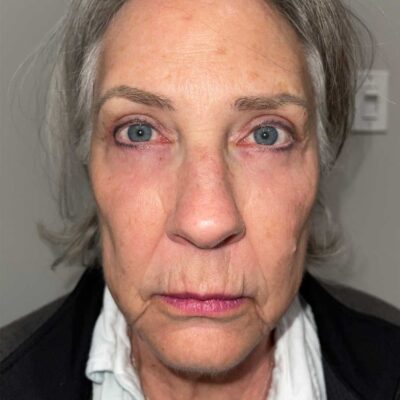 AFter- Full brow lift, bilateral upper lid ptosis repair, bilateral lower lid blepharoplasty, CO2 laser resurfacing lower eyelids