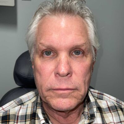 AFTER BUL ptosis repair, BLL blepharoplasty with tendon, CO2 laser resurfacing lower eyelids