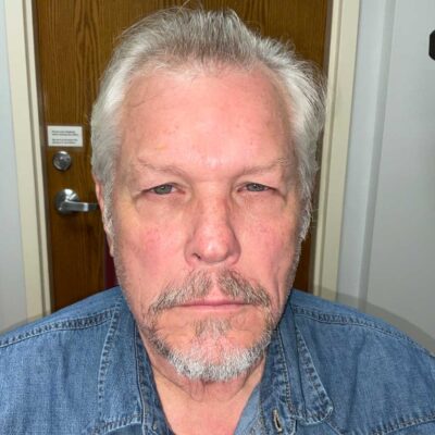 BUL ptosis repair, BLL blepharoplasty with tendon, CO2 laser resurfacing lower eyelids