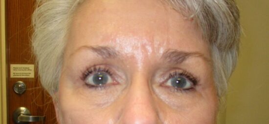 lateral brow lift, bilateral upper eyelid ptosis repair