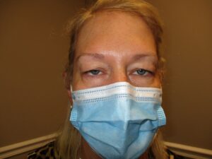 bilateral upper eyelid ptosis repair